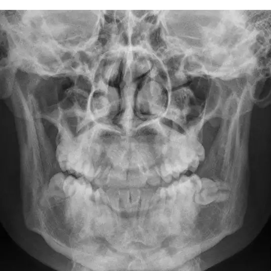 X-ray Mandible AP